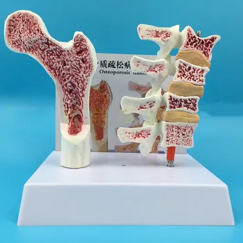 Анатомическая модель человека из ПВХ из 2 частей Остеопороз Бедренная кость Голень Образец разреза позвоночника Больной Поясничный отдел позвоночника